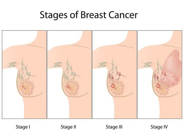 giai đoạn ung thư vú